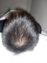 Hairloss