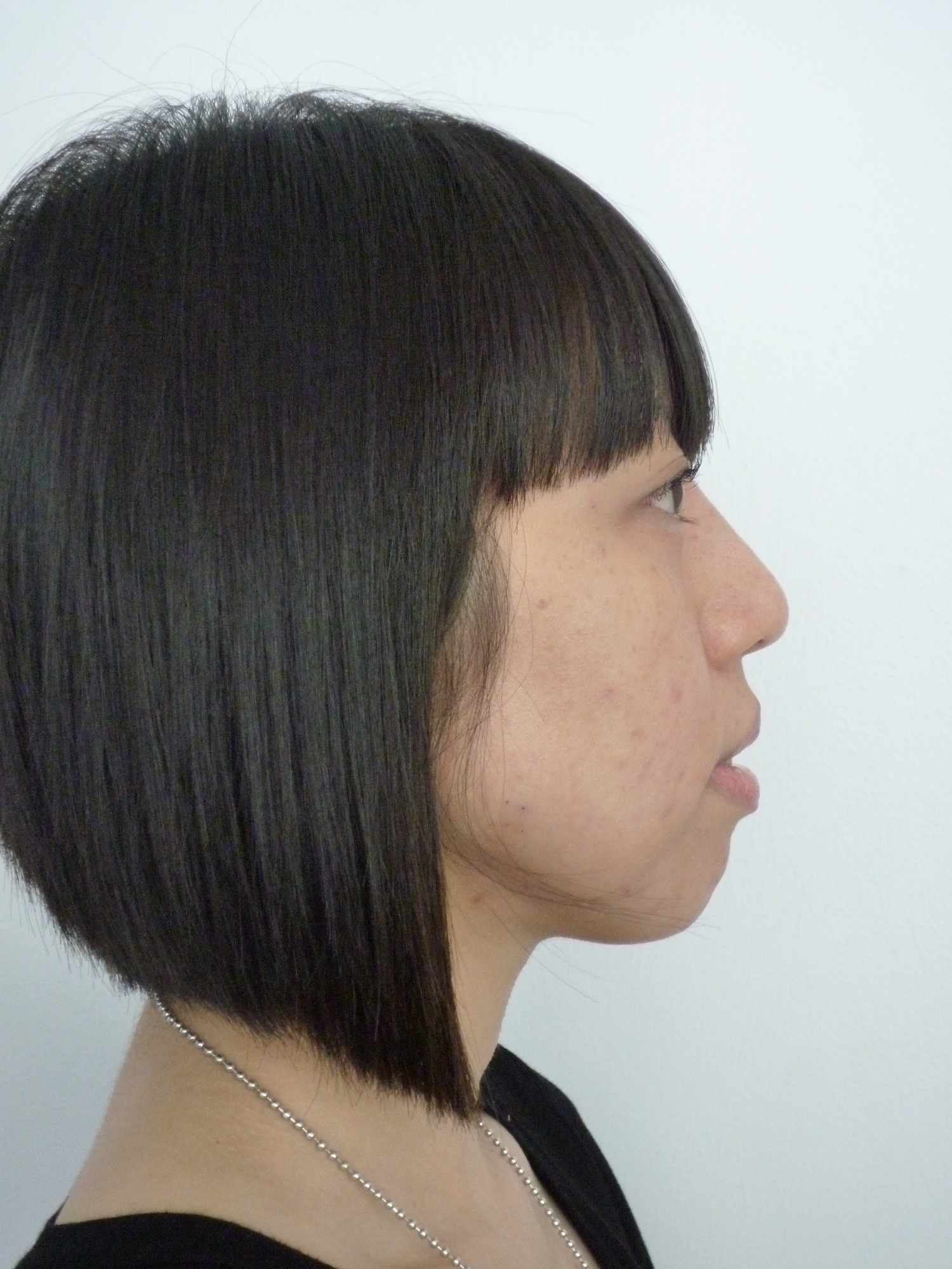 carol's sharper profile after fillers