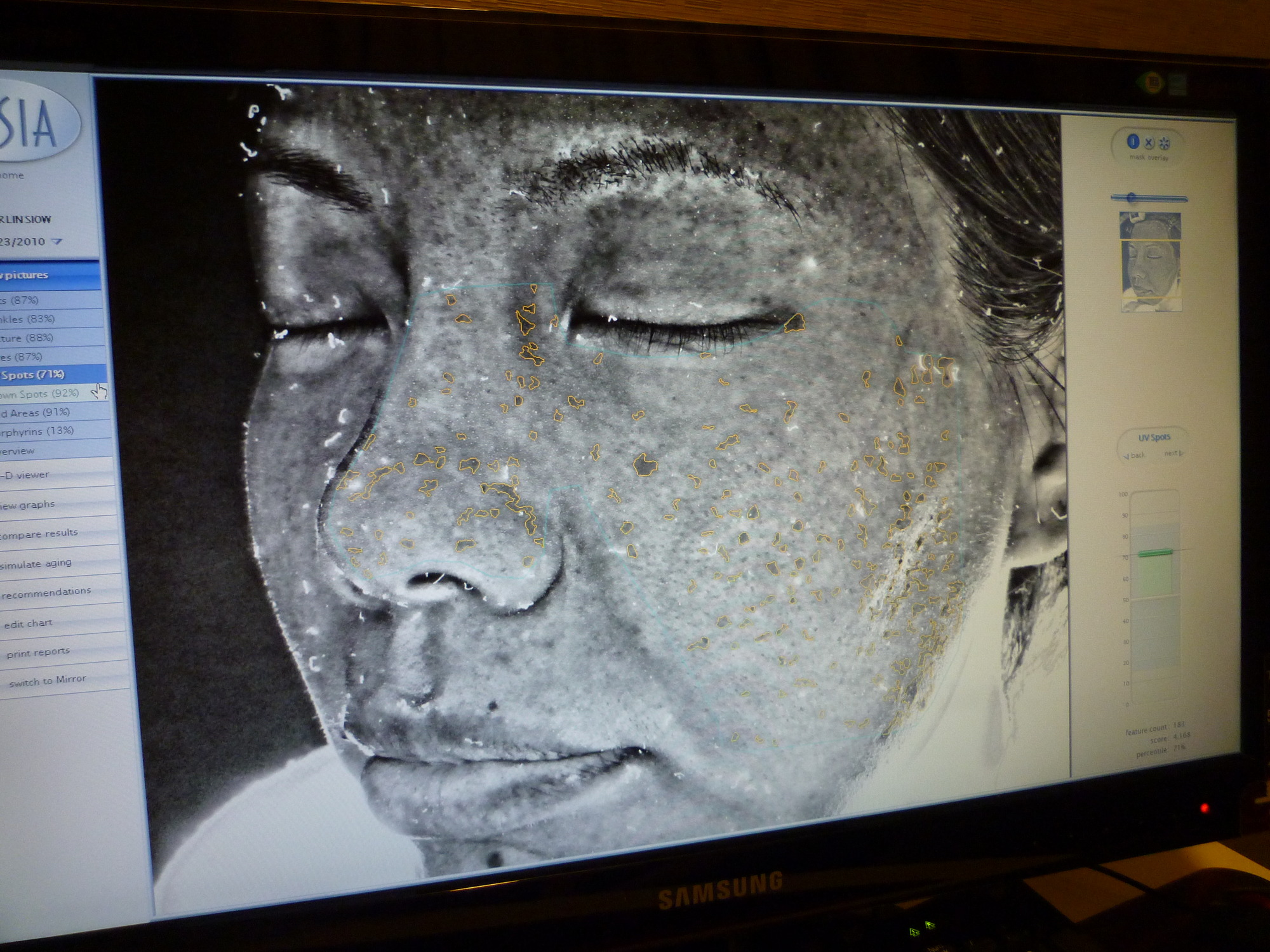 face analysis melasma check