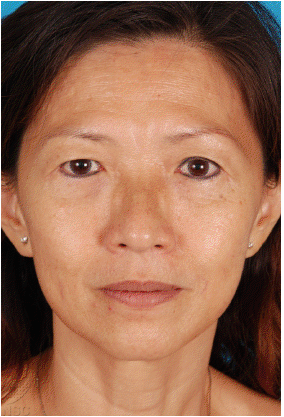 sculptra after
