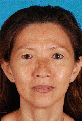 sculptra before