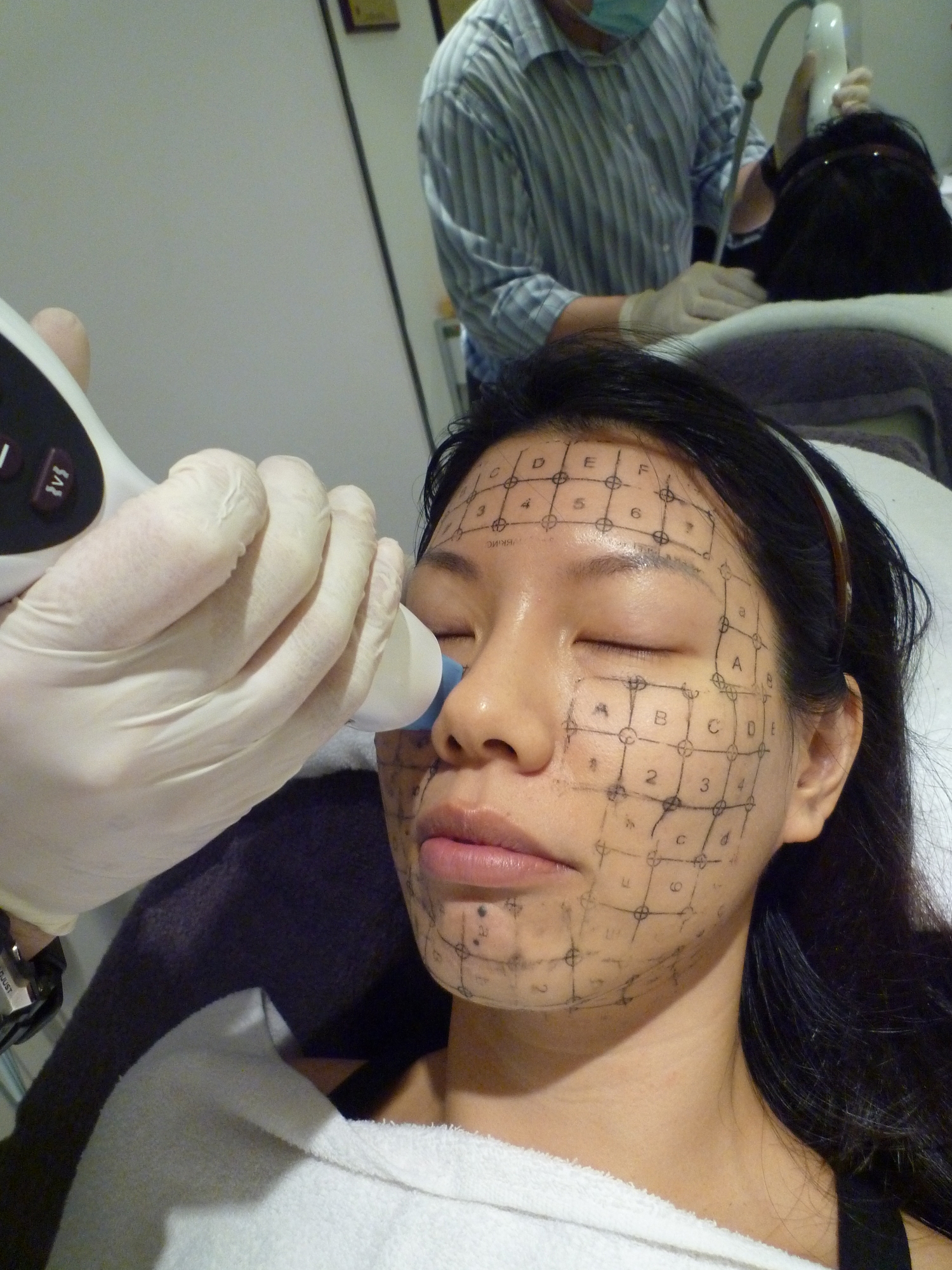 Thermage-CPT 50% off
