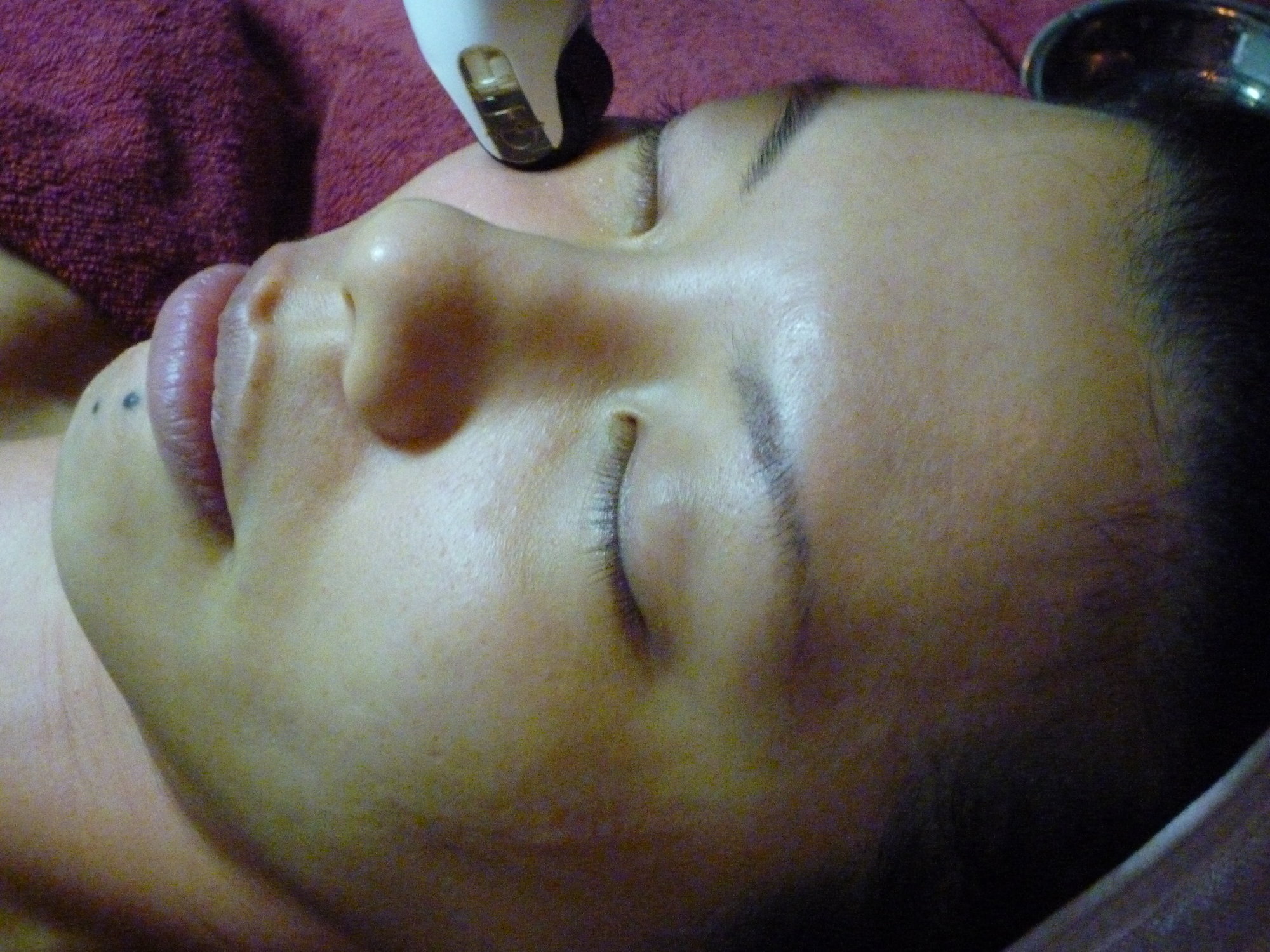 mesotherapy
